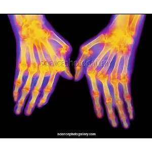   ray of hands with rheumatoid arthritis Framed Prints